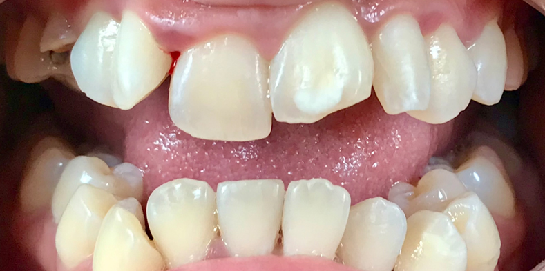 Image showing broken and chipped teeth