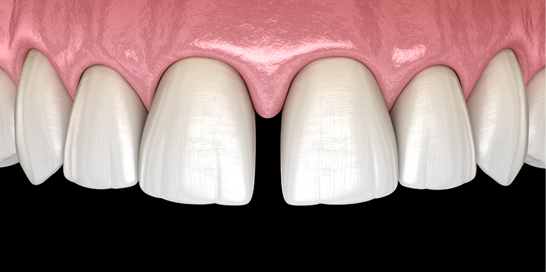 Dental gap image