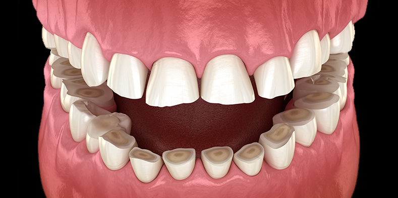 Worn teeth due to enamel erosion and dental wear