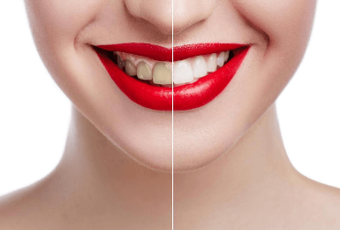 Teeth Whitening