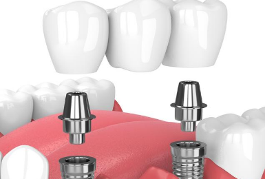 Dental implants